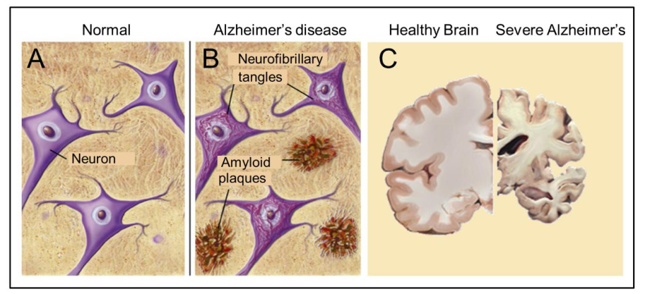 阿爾茨海默病的神經(jīng)基礎(chǔ)